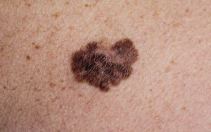 Picture of melanoma
